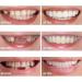 2 Pairs Temporarily Adjustable for Men and Women Beautiful Smile(White) - Buy Online on GoSupps.com