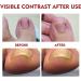 Ingrown Toenail Treatment Nail Growth Treatment Fungal Nail Treatment Ingrowing Toenail Treatment Ingrown Toenail Corrector Treatment for Ingrown Toenail Cuticle Oil Nail Strengthener for Damaged Nail - Buy Online on GoSupps.com