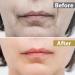 Anti Wrinkle Patches for Lip Smoothing Fine Lines&Wrinkles Silicone Patches for Smile Lines Overnight Lip Wrinkle Treatment 6 Count (Pack of 1) - Buy Online on GoSupps.com