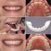 Flipped Warm Dentures: 2 Pairs of Provisional False Teeth for Men & Women | Upper & Lower Plug-In Solutions - Buy Online on GoSupps.com