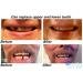 Instant Smile Multi-Shade Temporary Tooth Repair Kit - Patented Solution - Buy Online on GoSupps.com