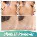 Wipe Off Tags and Mole Remover Skin Tag Remover & Mole Remover for Face Armpit Flesh Neck - Buy Online on GoSupps.com