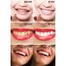Generic Ravishing Smiles Dental Grade Gel 0.02 Fl Oz (Pack of 250) Clear - Buy Online on GoSupps.com