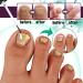 Fungal Nail Treatment Plant Essence Treatment Solution 30ML Special Nail Care Solution Athlete's Foot Toenails Broken Nails And Discolored Nails Restore Healthy Nails - Buy Online on GoSupps.com