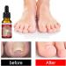 Ingrown Toenail Treatment Fungal Nail Treatment Ingrown Toenail Drops Nail Care and Treatment Strengthen Renew Damaged Nail(30ML) - Buy Online on GoSupps.com