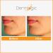 Dermlogic Acne Treatment Pads with Glycolic, Lactic, Salicylic Acid for Oily Skin, Clogged Pores, and Breakouts - Removes Dark Spots and Pimples on Face & Body - Buy Online on GoSupps.com