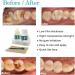 Tooth Repair Kit - Quick Fix for Damaged Teeth | Temporary Fillings & Bonding for Instant Dental Care - Buy Online on GoSupps.com