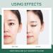 Anti Acne Cream for Acne Treatment and Spot Treatment with Nicotinamide Sodium Hyaluronate Aloe for Acne Prone & Sensitive Skin Reduce Redness Moisturiser Fade Acne Marks Oil Control - Buy Online on GoSupps.com