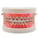 Standard Tooth Teaching Mallocclusion Orthodontic Teeth Model with Brackets Archwire Buccal Tube Tool