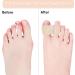 12 Pack Toe Spacers for Overlapping Toes - Toe Separators for Bunion and Hammertoe Straightening - Buy Online on GoSupps.com