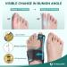 TENICORE Adjustable Bunion Corrector Toe Straightener - Double Non-slip Strap, Day Night Support for Women & Men - Buy Online on GoSupps.com