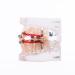 Easyinsmile Dental Orthodontic Treatment Model with Braces - Metal & Ceramic - Buy Online on GoSupps.com