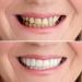 Temporary Dentures: Comfortable & Natural Fake Teeth for Confident Smiles (Size 1) - Buy Online on GoSupps.com