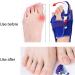 Bunion Toe Separators - Corrector for Hallux Valgus - Prevent Stretching and Deviation (Left) - Buy Online on GoSupps.com