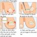 Toenail Tool 6 in 1 Ingrown Toe Nail Fixer Pedicure Toenail Recover Nail Foot Care Kit Ingrown Toenail Corrector for Men Women(24pcs) - Buy Online on GoSupps.com