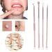 4-Piece Blackhead Remover Kit | Stainless Steel Acne Removal Tools & Comedon Extractor | Pimple Treatment Set - Buy Online on GoSupps.com