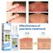 XWFJ Meellop Herbal Psoriasis Relief Spray - Soothes Eczema & Vitiligo, Repairs Skin - Face & Body - 1pc - Buy Online on GoSupps.com