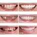 2 Pairs Adjustable Confident Smile Dental Aligners for Men & Women - White | Best International Shipping - Buy Online on GoSupps.com