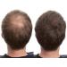 100% Natural Keratin Hair Fibre Refill for Hair Loss - Alopecia & Chemotherapy (25g) Light Brown - Pack of 1 - Buy Online on GoSupps.com