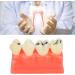 Ververt Touch Tooth Model - 180mm Dental Caries Demonstration Model for Schools & Dentists | Learning Aid for Dental Lessons - Buy Online on GoSupps.com