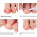 Ingrown Toenail Corrector Strips 10pcs Ingrown Toe Nail Strips Painless Paronychia Straightening Corrector Patches(Heavy effort) - Buy Online on GoSupps.com