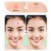 Shop Cute Star Acne Patches - Hydrocolloid Pimple Dots for Blemish Control | 36pc Pack - Fashionable Skin Care Treatment - Buy Online on GoSupps.com