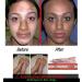 Bhandari Skinto Ointment 15g - For Pigmentation & White Spots on Skin - Buy Online on GoSupps.com