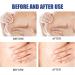 MIXCUT Silicone Scar Sheets for Breast Reduction Surgery - 8 Pack Scar Removal Strips: 4 Areola Soft Strips & 4 Anchor Sheets - Buy Online on GoSupps.com