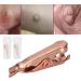 Skin Tags Clip Small Skin Tag Remove Chip Pure Copper Tag Clips Body Tag Extractor Skin Tag Remove Chip for Smooth Skin(#1) - Buy Online on GoSupps.com