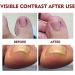 Huile de paronychia allemande pour enlever la paronychia traitement des ongles des pieds meilleure solution de r paration des ongles liquide de renouvellement des ongles endommag s (3 pi ces) 3 pi ces. - Buy Online on GoSupps.com