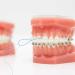 Dental Floss Threader for Braces & Implants - 300PCS (6 Pack) | Easy Flossing Solution - Buy Online on GoSupps.com