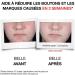 Neutrogena | Anti-Blemish+ Daily Face Serum (30 ml tube) - Buy Online on GoSupps.com