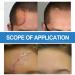 Silicone Scar Remover Gel - Effective for Old & New Scars - 1.06 oz - 3PCS Set - Buy Online on GoSupps.com