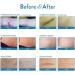 Aroamas Silicone Scar Removal Sheets 4-Pack - Effective for C-Section, Surgery, Burn, Keloid Scars - Soft Adhesive Fabric Strips - 2 Month Supply - Buy Online on GoSupps.com