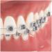 Dental Teeth Model - Orthodontic Study Tool with Metal & Ceramic for Demonstration - Buy Online on GoSupps.com