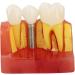 Verdant Touch Crown Bridge Demonstration Model - 4X Dental Implant Model for Doctor-Patient Education | International Shipping - Buy Online on GoSupps.com