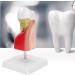 Verdant Touch Tooth Model - Dental Caries Teaching & Training Aid for Patient Education - International Shipping - Buy Online on GoSupps.com