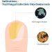 KTS Nail Fungus Cleaning Device - Rechargeable Laser Therapy for Onychomycosis | Portable & Easy to Use | 7 Minutes a Day | Rice White - Buy Online on GoSupps.com