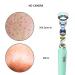 Womfenn Blackhead Remover 2022 - Advanced Pimple Popper with Camera | Acne Comedone Extractor Kit for Skin Care | Pore Clean Tool | 20X Zoom Aquamarine 01 - Buy Online on GoSupps.com