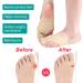 Buy Bale Toe Separator Protectors | Relief for Overlapping Toes & Hallux Valgus - Medium Size - Buy Online on GoSupps.com