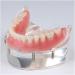 Dental Upper Implant Model - Overdenture Restoration with Transparent Teeth & Soft Gum - Ideal for Education & Study - Buy Online on GoSupps.com