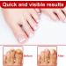 XPEX 30ml Mycose Ongles Des Pieds Strengthens and Revitalizes Nails pour Nails Damaged by Mycosis or Light Trauma pour D color s Endommag s et pais - Buy Online on GoSupps.com