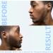 Angel Kiss Beard Derma Roller for Men - Titanium Microneedle Roller for Patchy Hair Growth - Home Use with Storage Case, Black 0.5 - Buy Online on GoSupps.com