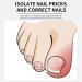 50pcs Ingrown Toenail Treatment Kit - Correction Strips, Patches, Clips & Clippers for Foot Care - Buy Online on GoSupps.com