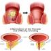Eetwsw Heca Natural Herbal Hemorrhoid Relief Capsules - Fast & Efficient Pain Relief - 2pcs - Buy Online on GoSupps.com