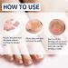 100 PCS Breathable Self-Adhesive Toenail Correction Patch - Ingrown Toenail Corrector Stickers Blue - Buy Online on GoSupps.com