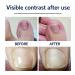 Toenail Correction Patch 100PCS - Professional Ingrown Toenail Corrector Strips for Foot Care - Health Toenail Treatment Tool for Glue-Free Nail Correction - Blue - Buy Online on GoSupps.com