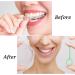 Buy Nitaiun 8-Piece Invisible Tooth Removal Kit - 2 Braces & 6 Aligner Distance Tools with Storage Case | International Shipping Available - Buy Online on GoSupps.com