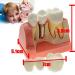 Dental Implant Analysis Demonstration Model - Crown Bridge Teeth Interpretation Model - Buy Online on GoSupps.com