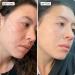 SONYA DAKAR Super Clear Serum - Acne Fighting with Salicylic Acid & Niacinamide | Minimize Pores Reduce Inflammation & Blemishes | International Shipping Available - Buy Online on GoSupps.com